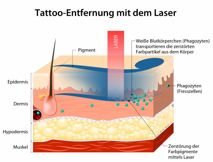 Tattooentfernung mit dem Laser