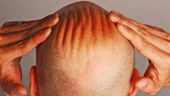 Männer mit Haarausfall für klinische Studie gesucht