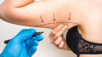 Inwiefern bleiben Narben nach einer operativen Oberarmstraffung sichtbar?