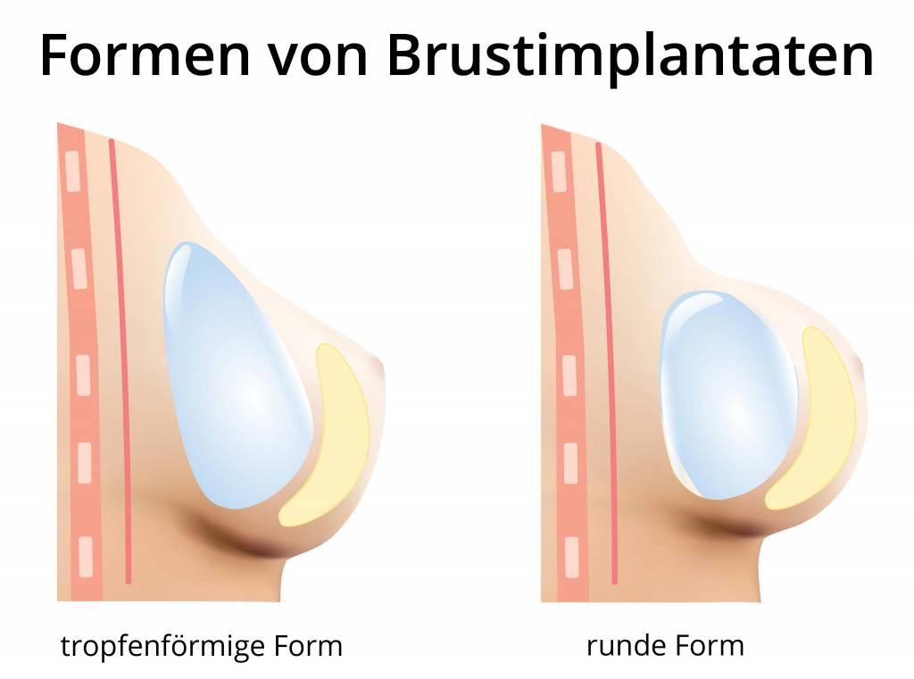 Welche Implantatformen gibt es bei einer Brustvergrerung?