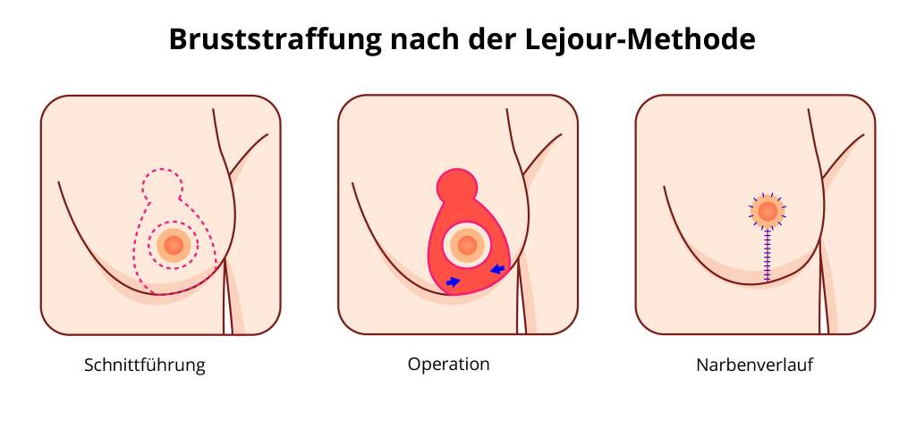 Schwangerschaft vorher nachher brustwarzen Tubuläre Brustdeformität