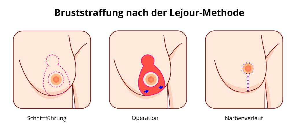 Schwangerschaft vorher nachher brustwarzen Tubuläre Brustdeformität