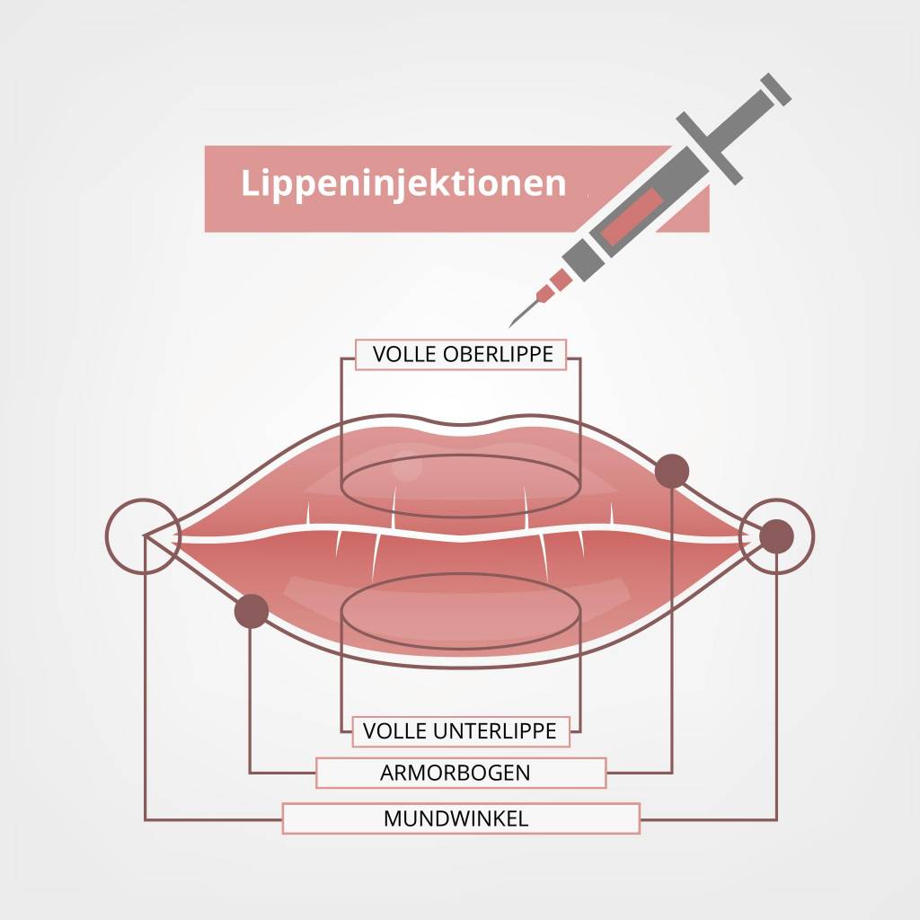 Wie lange geschwollen lippen aufspritzen Wann geht