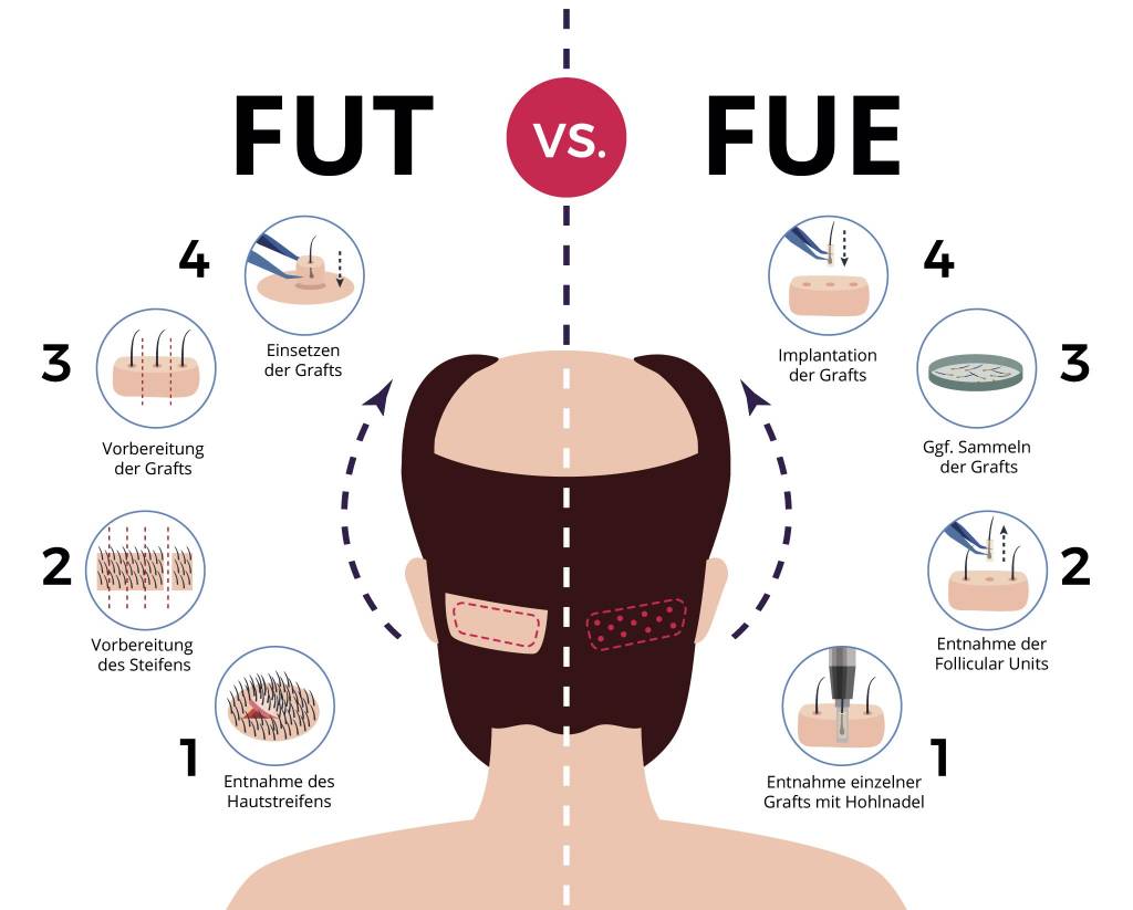 Haartransplantation Methoden Verlauf Erfolg Und Kosten