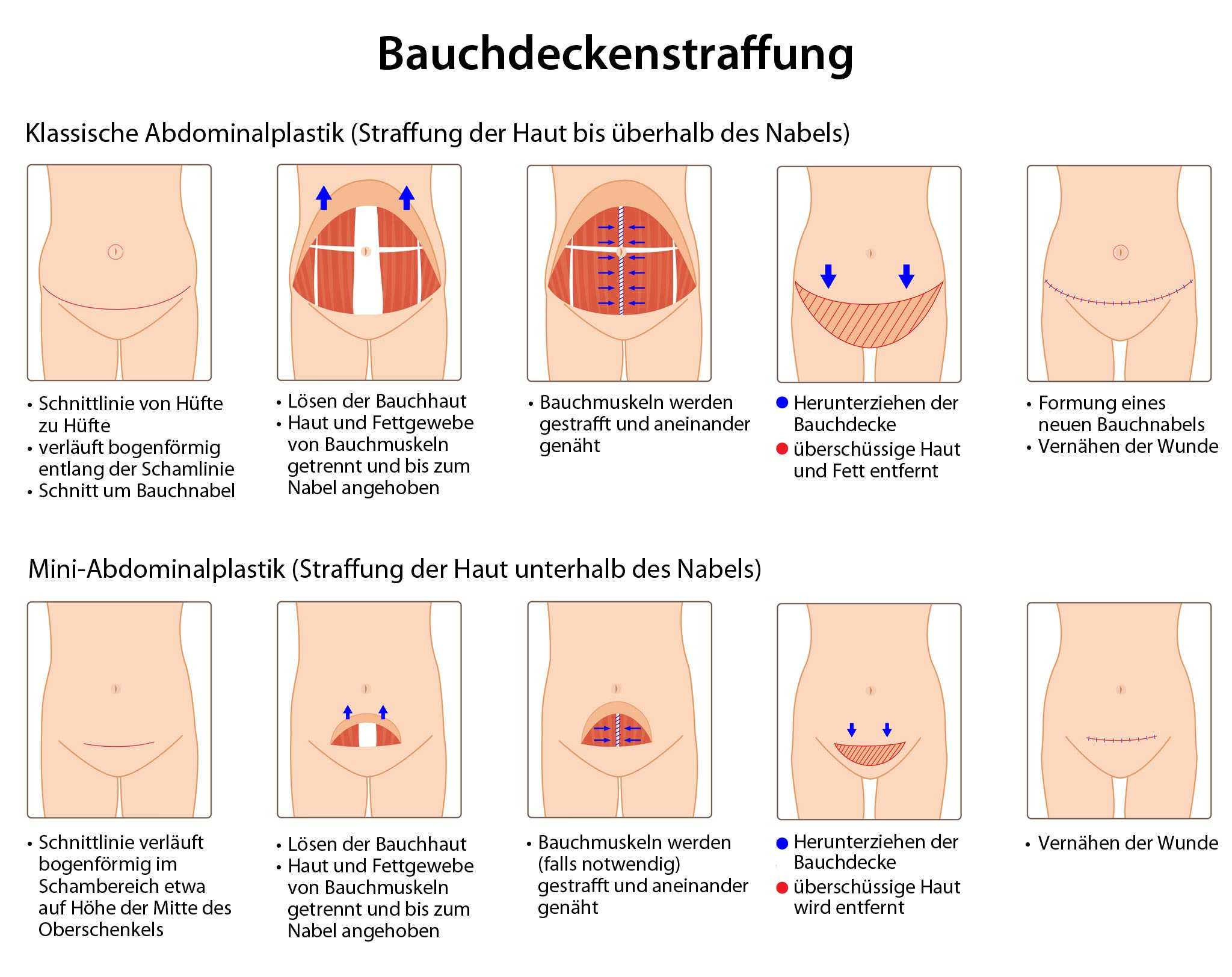 Haut bauchdeckenstraffung schlaffe nach Bauchdeckenstraffung: OP