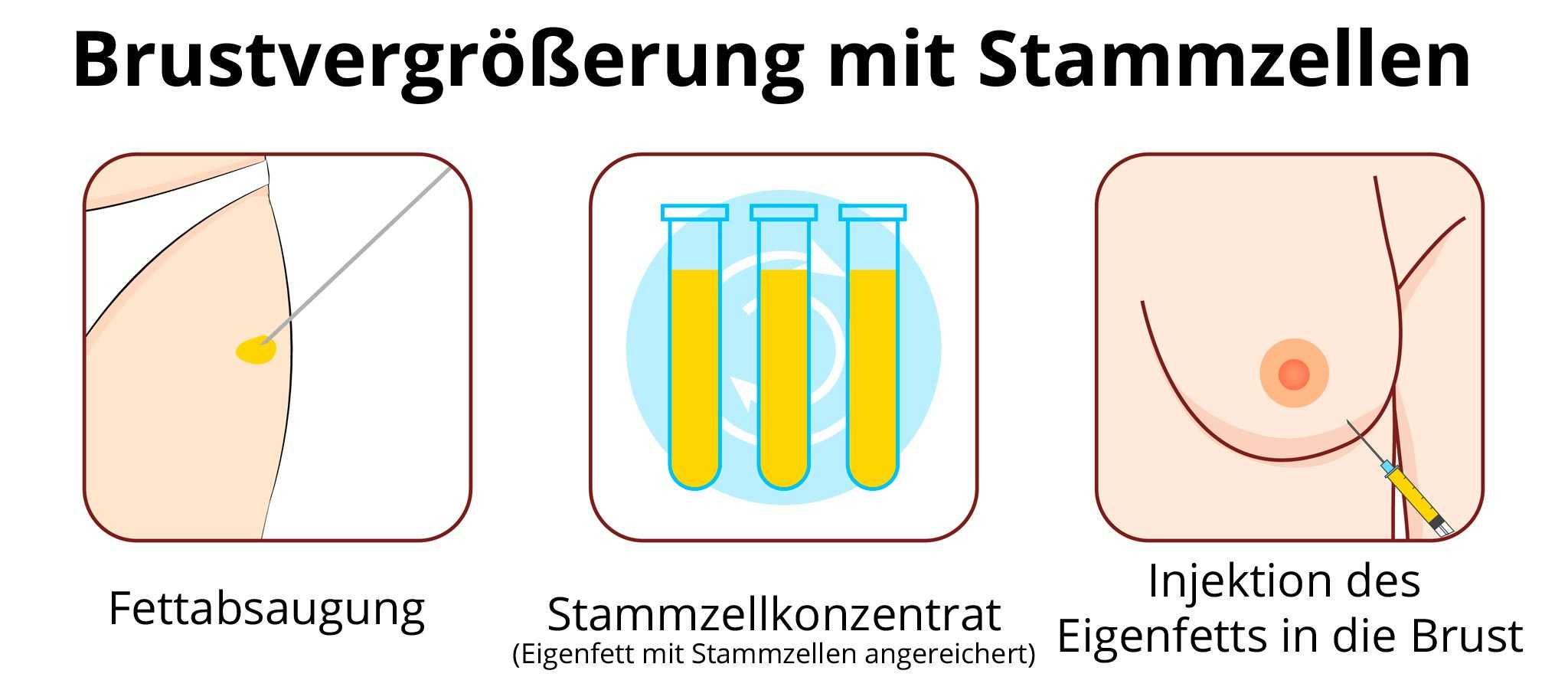 Brustvergrößerung erfahrungen Brustvergrößerung über