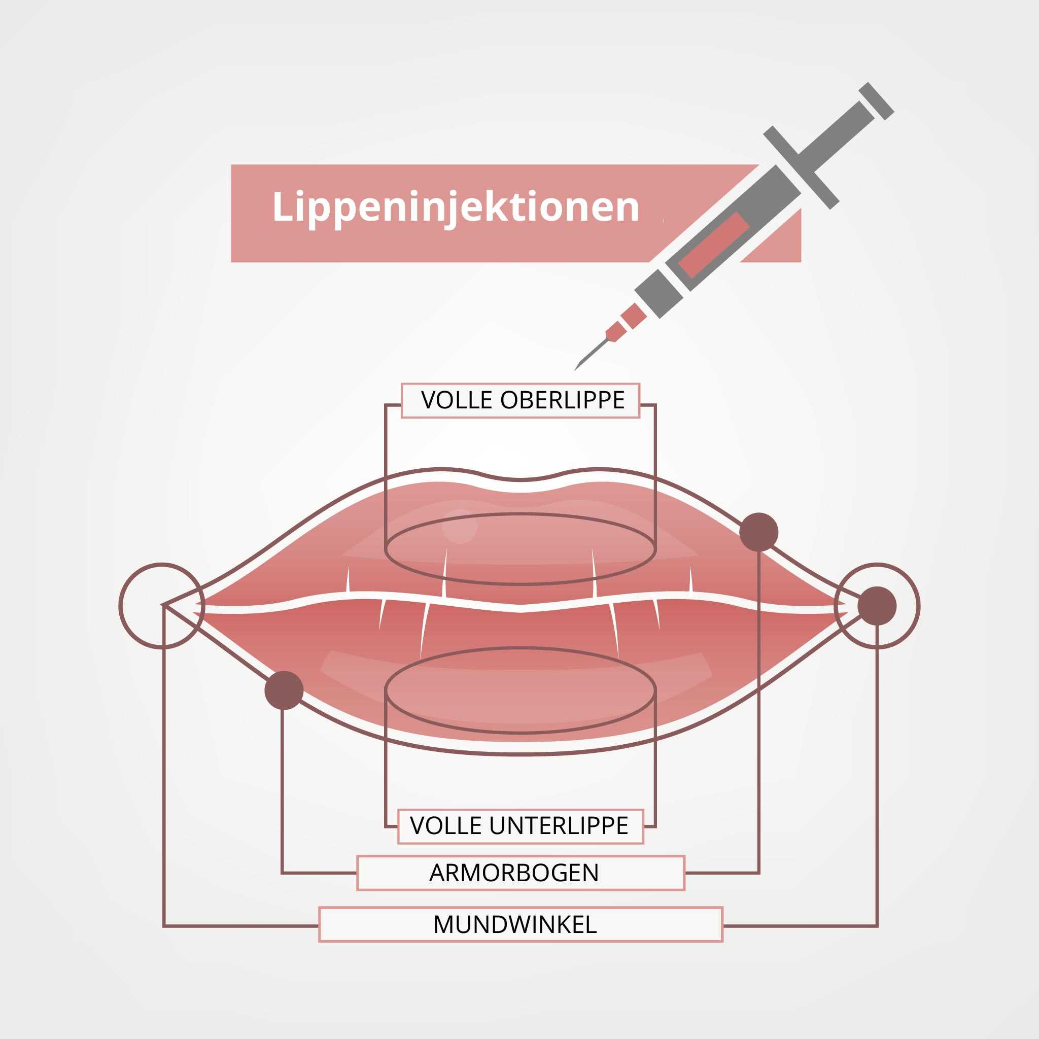 Lippenvergrößerung » Methoden im Überblick