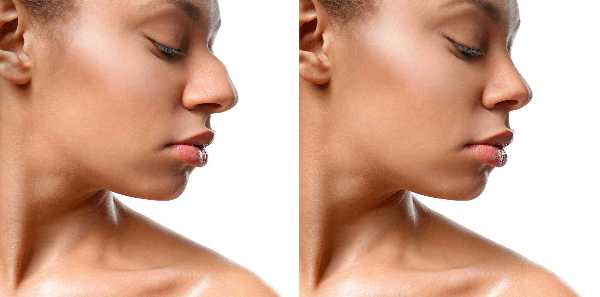 Frauen nasenkorrektur vorher nachher bilder Nasenkorrektur in