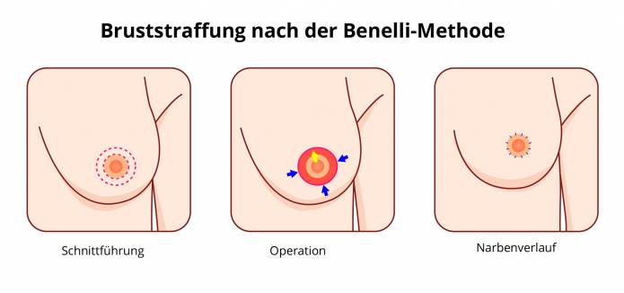 Bruststraffung nach der Benelli-Methode