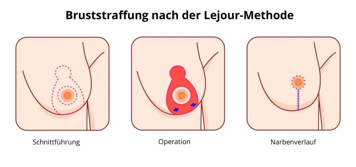 Bruststraffung nach der Lejour-Methode