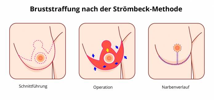 Bruststraffung nach der Störmbeck-Methode