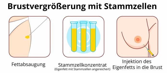 Brustvergrößerung mit Stammzellen