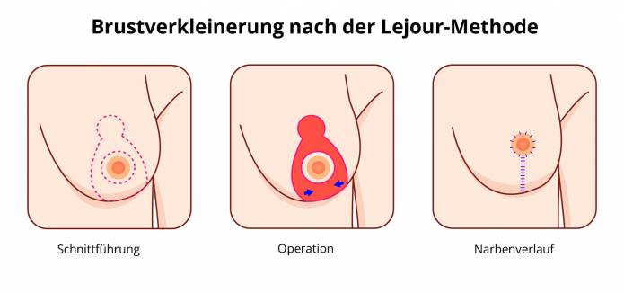 Brustverkleinerung nach der Lejour-Methode