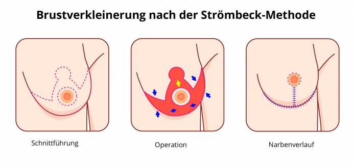 Brustverkleinerung Strömbeck-Methode