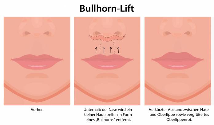 Bullhorn-Lift