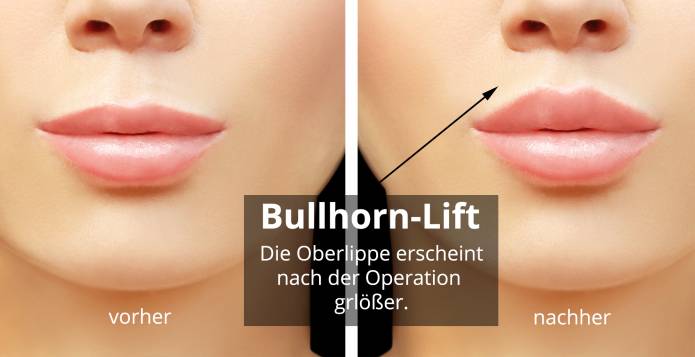 Bullhorn Lift vorher nachher