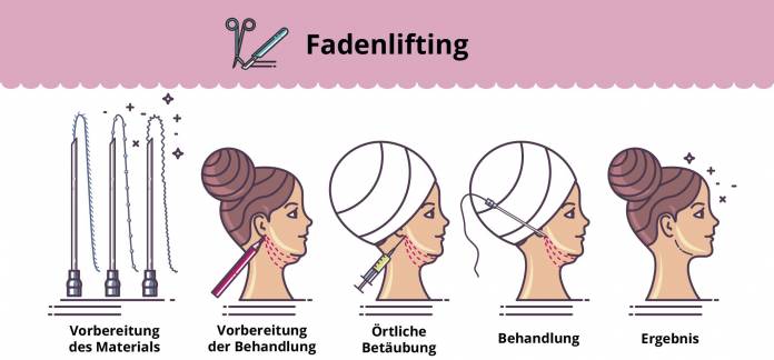 Fadenlifting