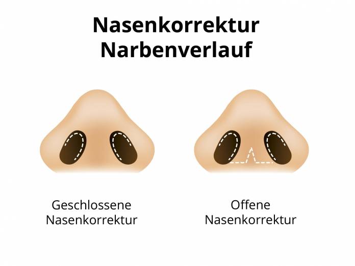 Geschlossene / Offene Nasenkorrektur