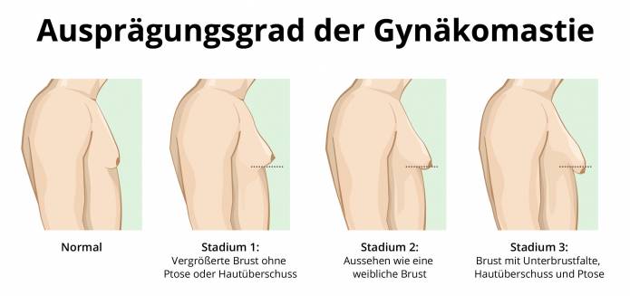 Stadien der Gynäkomastie (Ausprägungsgrad)