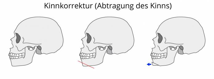 Kinnkorrektur