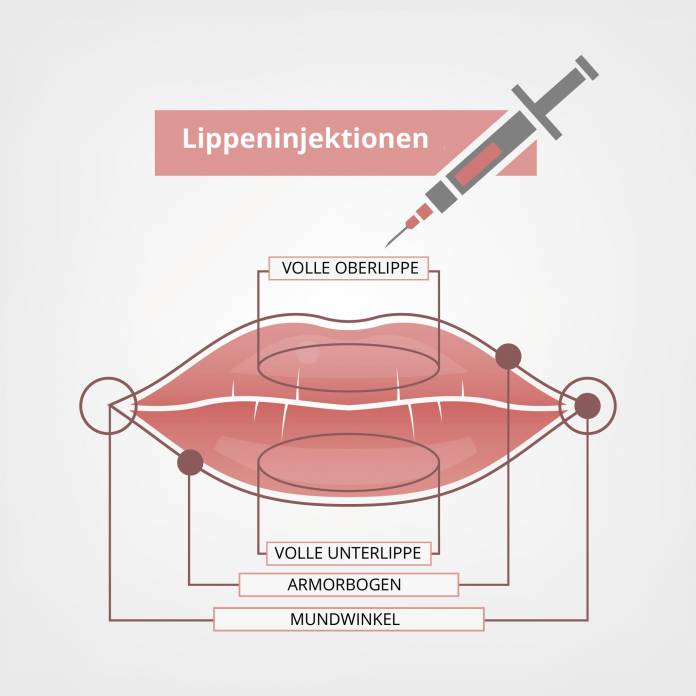 Lippeninjektion