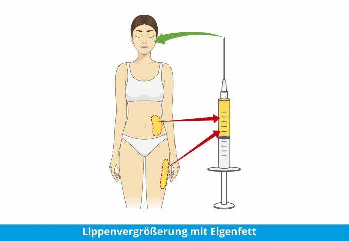 Lippenvergrößerung mit Eigenfett