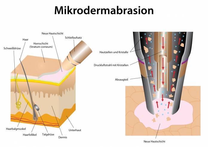 Mikrodermabrasion
