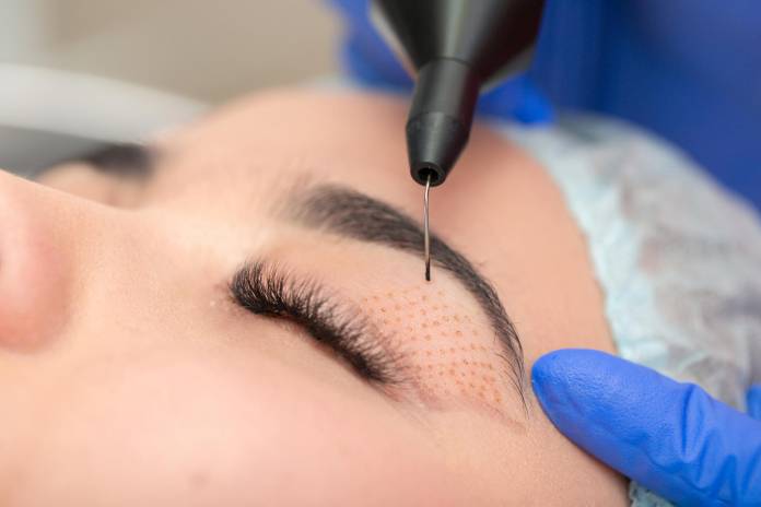 Oberlidstraffung mit Plasma-Pen » Methode, Ablauf, Nachsorge