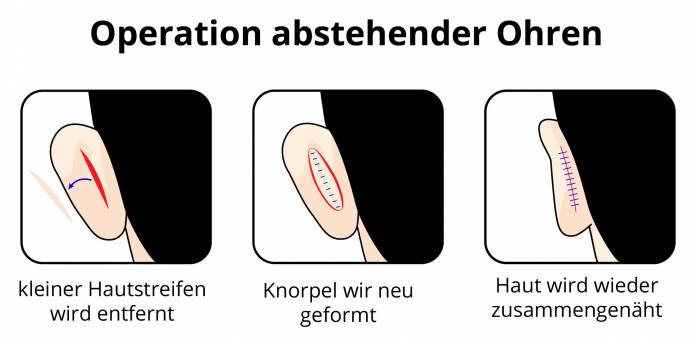 Operation abstehender Ohren