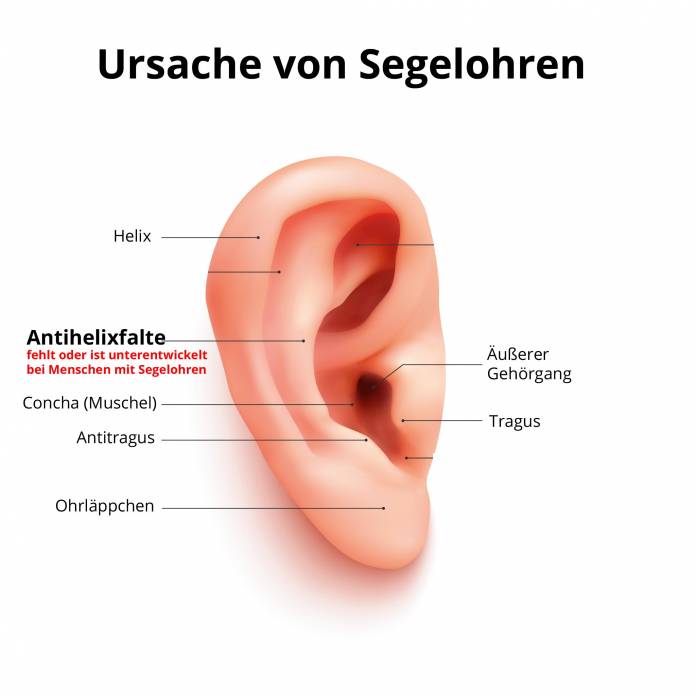 Ursache abstehende Ohren