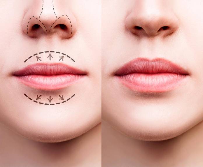 Vergrößerung der Lippen