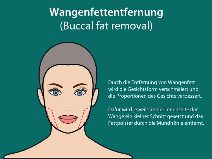 Wangenfettentfernung (Buccal fat removal)